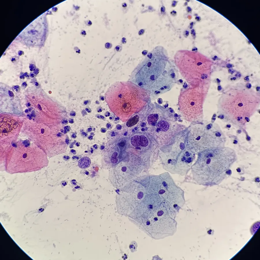 Cervical cytology smear showing LSIL with koilocytotic changes