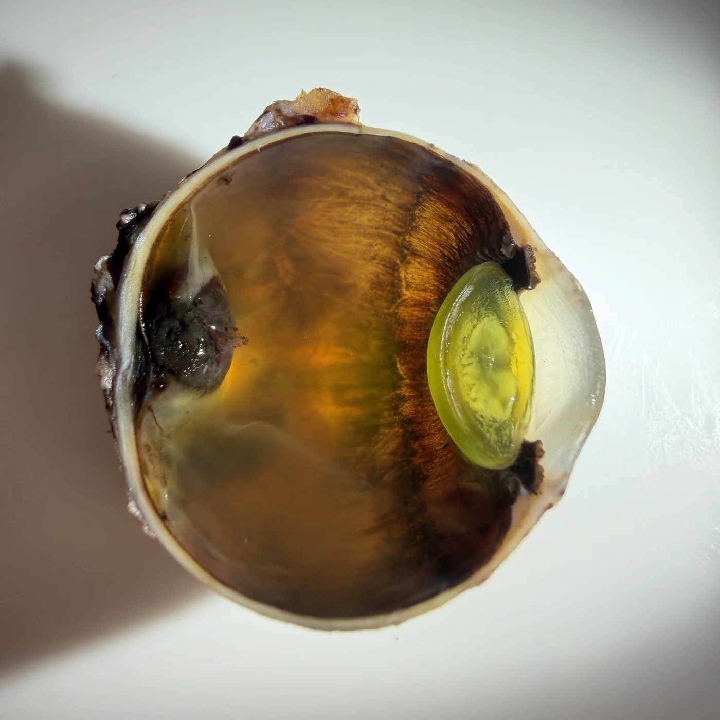 Bisected eye globe specimen, alternate angle showing the melanoma's extent